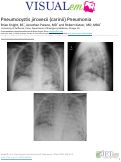 Cover page: Pneumocystis jirovecii (carinii) Pneumonia