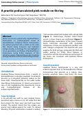 Cover page: A pruritic pedunculated pink nodule on the leg