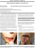 Cover page: Oral Lesions Secondary to Cocaine Use