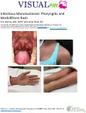 Cover page: Infectious Mononucleosis: Pharyngitis and Morbilliform Rash