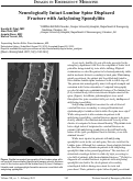 Cover page: Neurologically Intact Lumbar Spine Displaced Fracture with Ankylosing Spondylitis