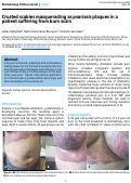 Cover page: Crusted scabies masquerading as psoriasis plaques in a patient suffering from burn scars