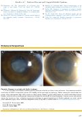 Cover page: Phacolytic Glaucoma in an Adult with Stickler Syndrome