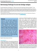 Cover page: Dermoscopy findings of a one mm lentigo maligna