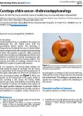 Cover page: Curettage of skin cancer-the bruised apple analogy