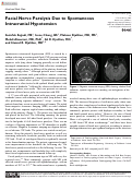 Cover page: Facial Nerve Paralysis Due to Spontaneous Intracranial Hypotension