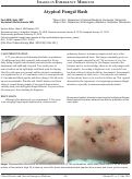 Cover page: Atypical Fungal Rash