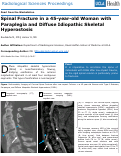 Cover page: Spinal Fracture in a 45-year-old Woman with Paraplegia and Diffuse Idiopathic Skeletal Hyperostosis
