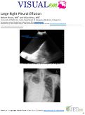 Cover page: Large Right Pleural Effusion