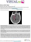 Cover page: Dense MCA Sign