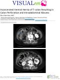 Cover page: Incarcerated Ventral Hernia of T-colon Resulting in Colon Perforation and Intraabdominal Abscess