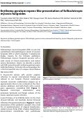 Cover page: Erythema gyratum repens-like presentation of folliculotropic mycosis fungoides