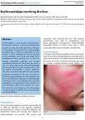 Cover page: Erythromelalgia involving the face