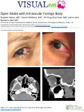 Cover page: Open Globe with Intraocular Foreign Body