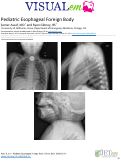 Cover page: Pediatric Esophageal Foreign Body