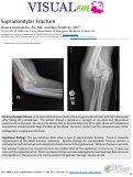 Cover page: Supracondylar Fracture