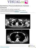 Cover page: Spontaneous Pneumomediastinum: Hamman Syndrome