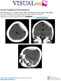 Cover page: Acute Subdural Hematoma