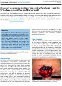 Cover page: A case of melanoma in situ of the central forehead repair by V-Y advancement flap and Burow graft