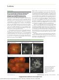 Cover page: Phase-Variance Optical Coherence Tomographic Angiography Imaging of Choroidal Perfusion Changes Associated With Acute Posterior Multifocal Placoid Pigment Epitheliopathy