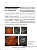 Cover page: Phase-Variance Optical Coherence Tomographic Angiography Imaging of Choroidal Perfusion Changes Associated With Acute Posterior Multifocal Placoid Pigment Epitheliopathy