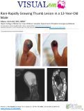 Cover page: Rare Rapidly Growing Thumb Lesion in a 12-Year-Old Male