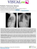 Cover page: Pediatric Pulmonary Abscess