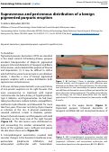 Cover page: Supravenous and perivenous distribution of a benign pigmented purpuric eruption