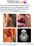 Cover page: An Unusual Case of Pharyngitis: Herpes Zoster of Cranial Nerves 9, 10, C2, C3 Mimicking a Tumor