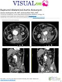 Cover page: Ruptured Abdominal Aortic Aneurysm