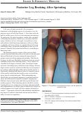 Cover page: Posterior Leg Bruising After Sprinting