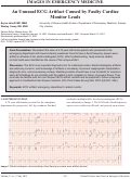 Cover page: An Unusual ECG Artifact Caused by Faulty Cardiac Monitor Leads