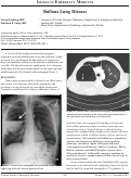 Cover page: Bullous Lung Disease
