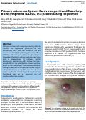 Cover page: Primary cutaneous Epstein-Barr virus-positive diffuse large B-cell lymphoma (DLBCL) in a patient taking fingolimod