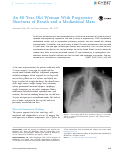 Cover page: An 80-Year-Old Woman With Progressive Shortness of Breath and a Mediastinal Mass