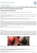 Cover page: Curative Resection of T1a Inlet Patch Adenocarcinoma With Traction-Assisted Endoscopic Submucosal Dissection.