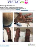 Cover page: Pemphigoid Gestationis