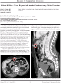 Cover page: Silent Killer: Case Report of Acute Gastrostomy Tube Erosion