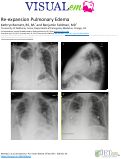 Cover page: Re-expansion Pulmonary Edema