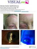 Cover page: Herpes Zoster Ophthalmicus