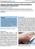 Cover page: Cutaneous dystrophic calcification following high-dose radiotherapy for a liposarcoma