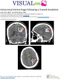 Cover page: Intracranial Hemorrhage Following a 3-week Headache