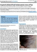Cover page: Acquired unilateral facial melanocytosis: nevus of Sun