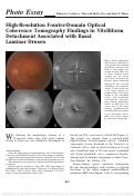 Cover page: High-resolution Fourier-domain optical coherence tomography findings in vitelliform detachment associated with basal laminar drusen.