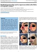 Cover page: Modified keystone flap used to repair nose defect after Mohs micrographic surgery