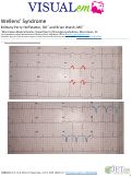 Cover page: Wellens’ Syndrome