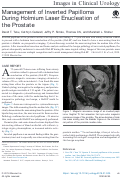 Cover page: Management of Inverted Papilloma During Holmium Laser Enucleation of the Prostate.