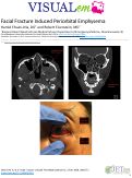 Cover page: Facial Fracture Induced Periorbital Emphysema