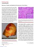 Cover page: Mucinous Tubular and Spindle Cell Carcinoma of the Kidney