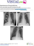 Cover page: Spontaneous Pneumothorax